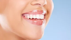 advantages of dental laminates