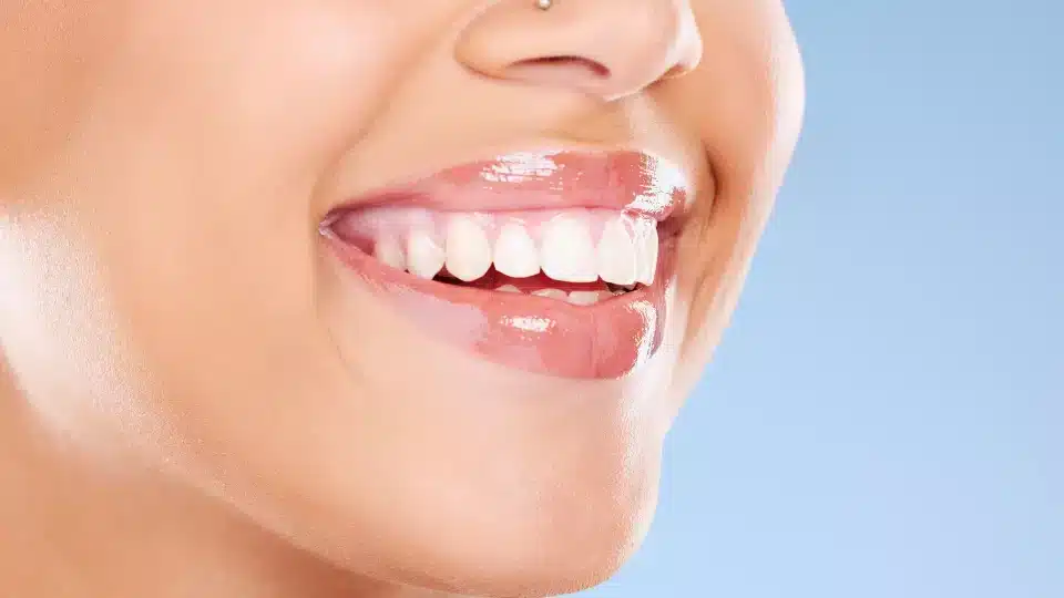advantages of dental laminates
