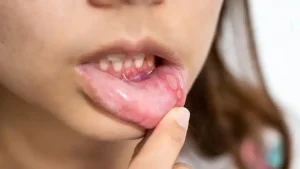 common causes of mouth sores