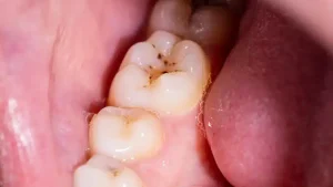 dental calculus and plaque