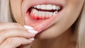 gum bleeding treatment