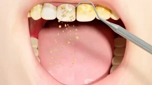 preventing dental calculus