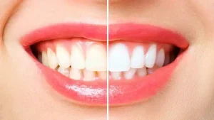 teeth whitening methods