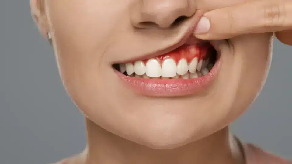 tooth abscess