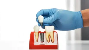 types of dental implants